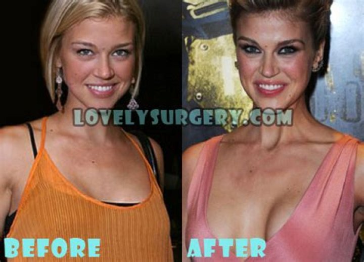 Adrianne Palicki Plastic Surgery Before and After