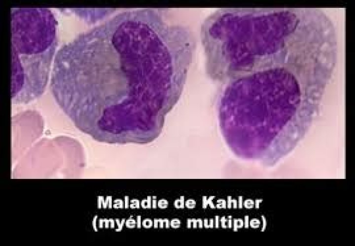 Maladie De Kahler Bourvil