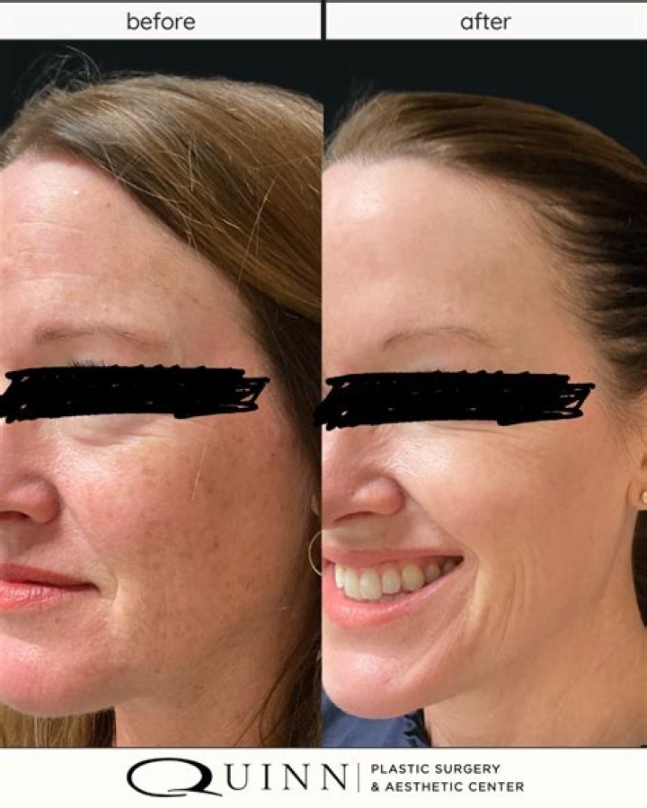 Molly Quinn Plastic Surgery Before and After